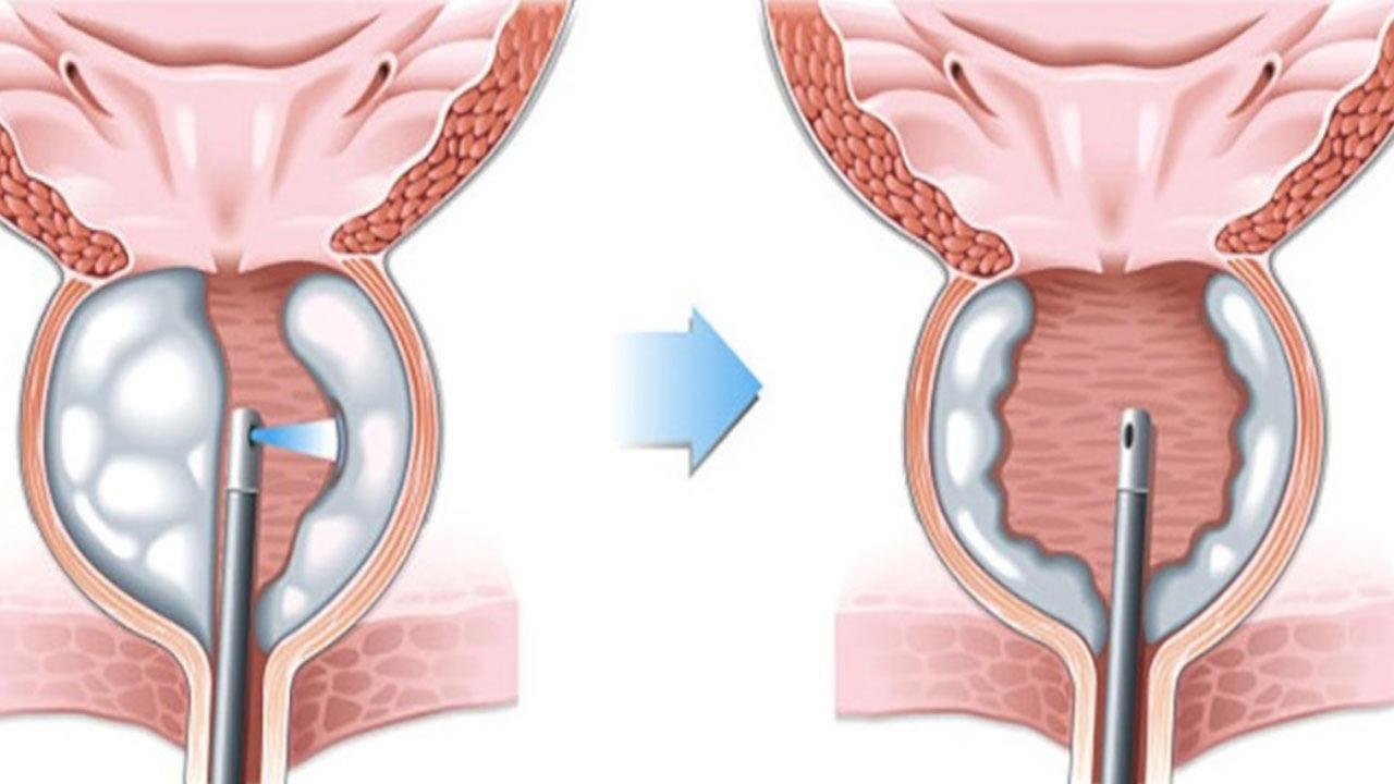 Prostat Hastalığında bir devrim! HoLEP ameliyatı nasıl yapılır?